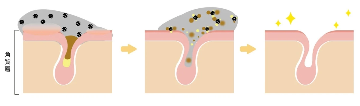 毛穴の汚れが除去され、きれいな肌になるまでの過程のイラスト